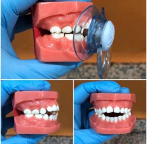 mordida-abierta-chupete